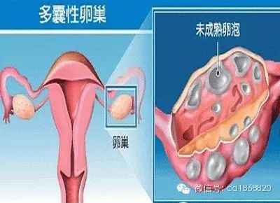 多囊卵巢综合症怎么治疗?能怀孕吗-怀孕期