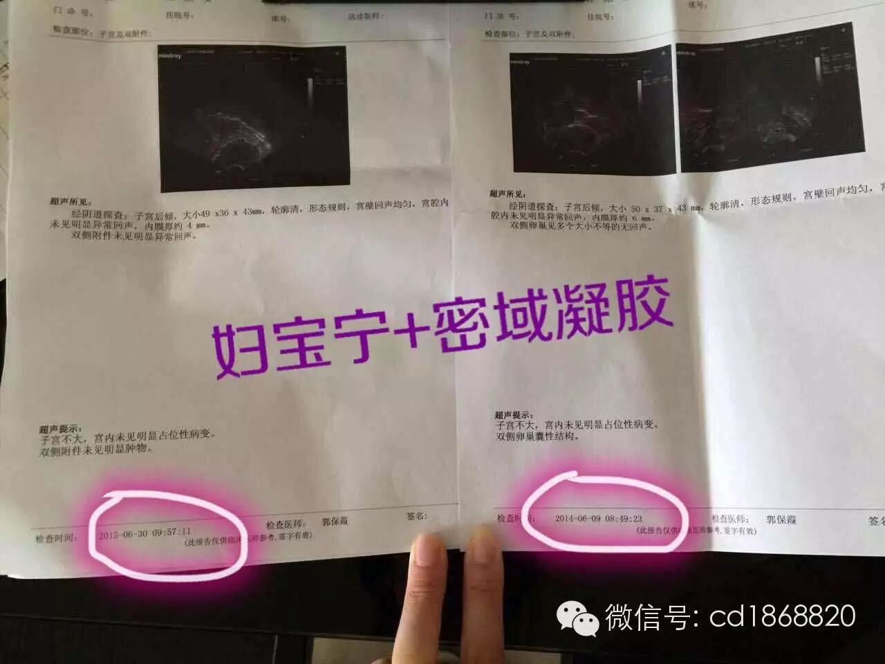 多囊卵巢综合症怎么治疗?能怀孕吗-怀孕期