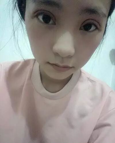 全程直播 | 全切雙眼皮，一個月變蘿莉！