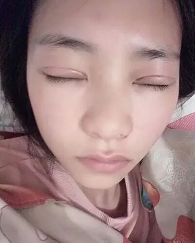 全程直播 | 全切雙眼皮，一個月變蘿莉！