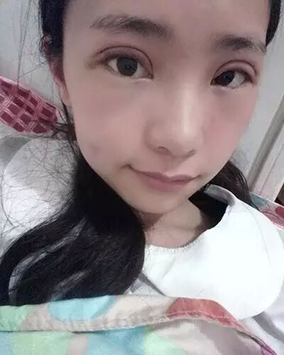 全程直播 | 全切雙眼皮，一個月變蘿莉！