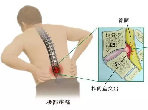 ☞一个药方和一个动作，腰椎间盘突出症一个月痊愈了！