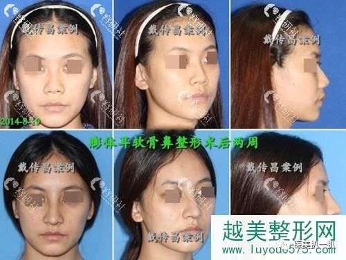 从隆鼻案例看上海九院戴传昌,必当归柳济圣做鼻子风格差异