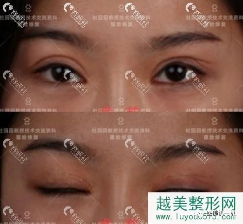 双眼皮疤痕明显修复多次,找上海联合丽格杜园园一次就搞定