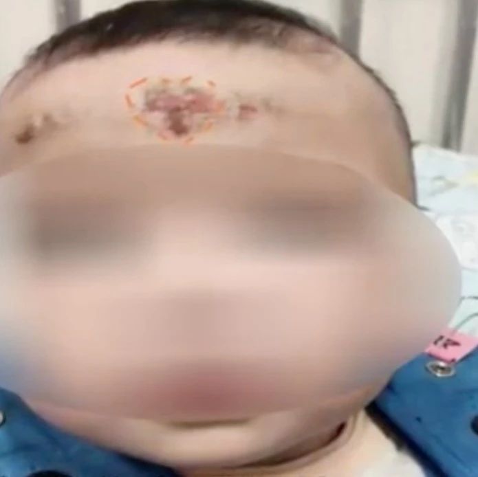 10个月婴儿面部溃烂！竟是外婆一个动作导致！医生紧急提醒