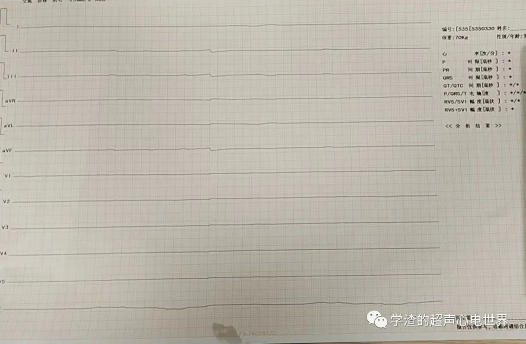 心电图如何报告死亡与濒死心电图​诊断