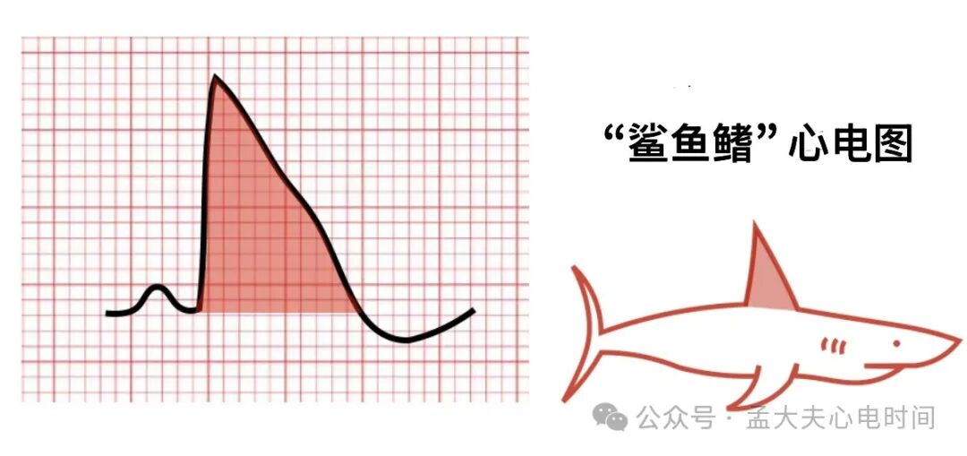 右束支阻滞合并心肌梗死心电图诊断及鉴别