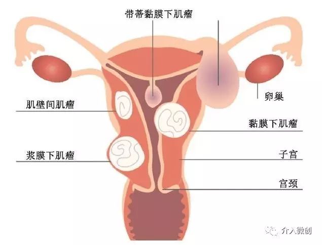 当怀孕遇上子宫肌瘤 怎么办 子宫肌瘤 子宫肌瘤孕产