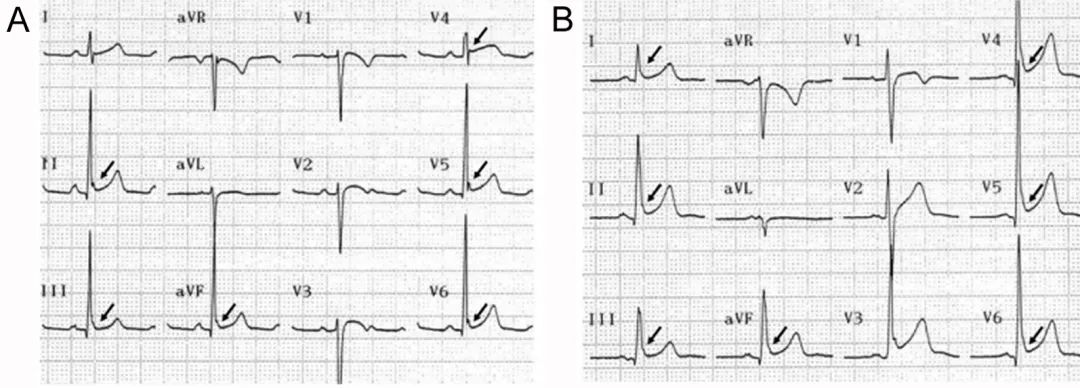 这些特征心电图改变，都是猝死的前兆