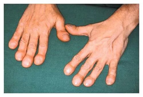 手上有这标志，肺癌或已“盯”上你！中老年千万要重视！