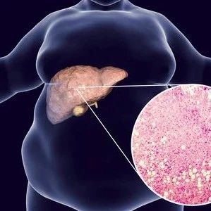 不用节食、不用运动就能逆转脂肪肝？科学家发现潜在新疗法！