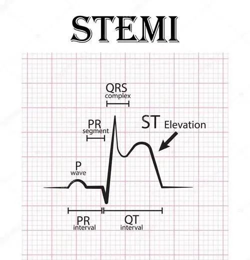 【厉害了】四步法快速定心梗部位和范围