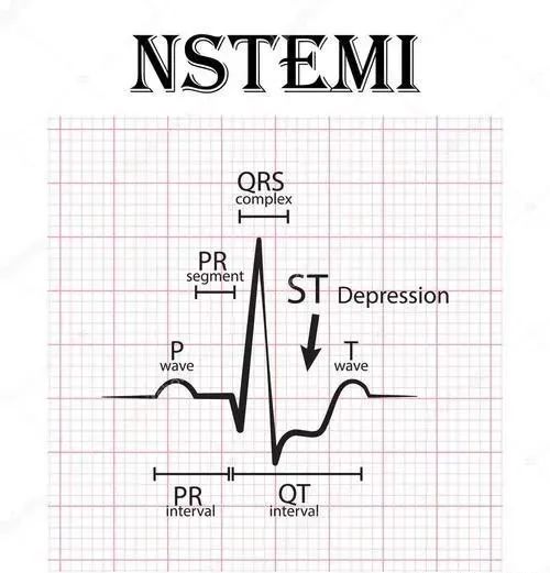 【厉害了】四步法快速定心梗部位和范围