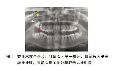 上颌第一磨牙全牙进入上颌窦，如何处理？