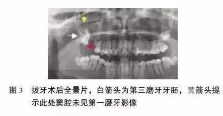 上颌第一磨牙全牙进入上颌窦，如何处理？