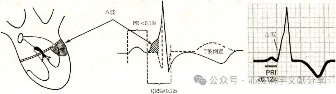 预激综合征的诊断及治疗原则