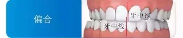中线不齐、脸歪，能通过正畸改善吗？