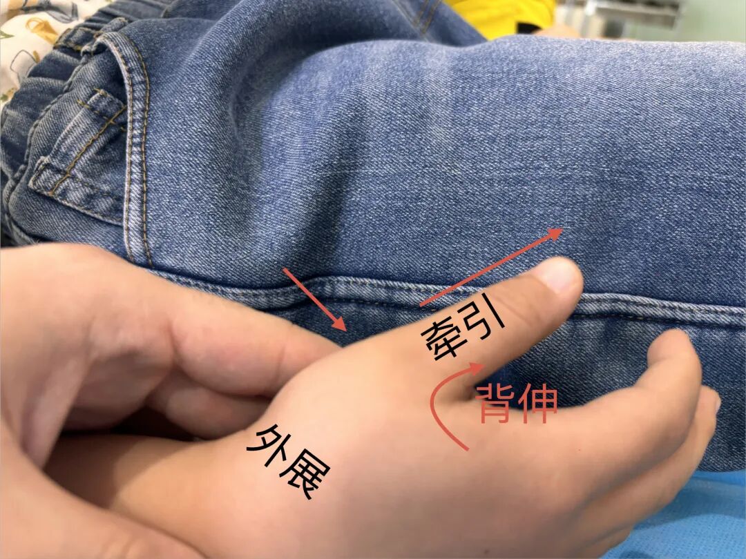 闭合复位治疗：儿童第