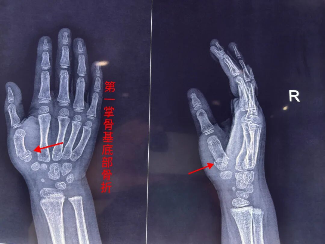 闭合复位治疗：儿童第