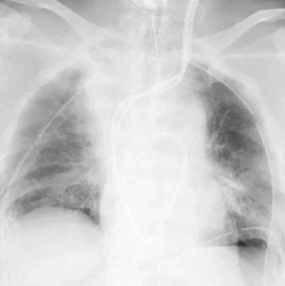 日本完成首例新冠肺炎患者活体肺移植手术丨环球科学要闻