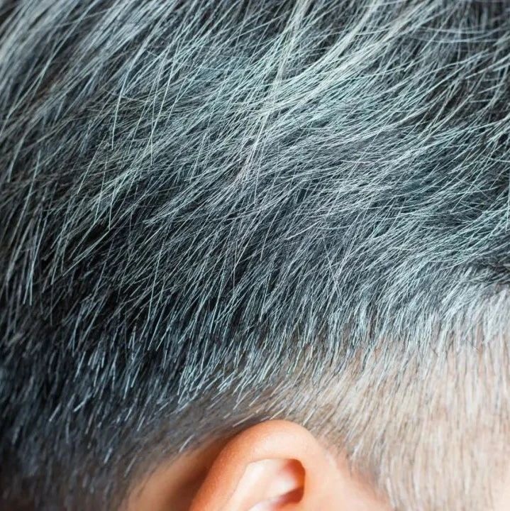 “少白头”能恢复吗？如何预防白头发？