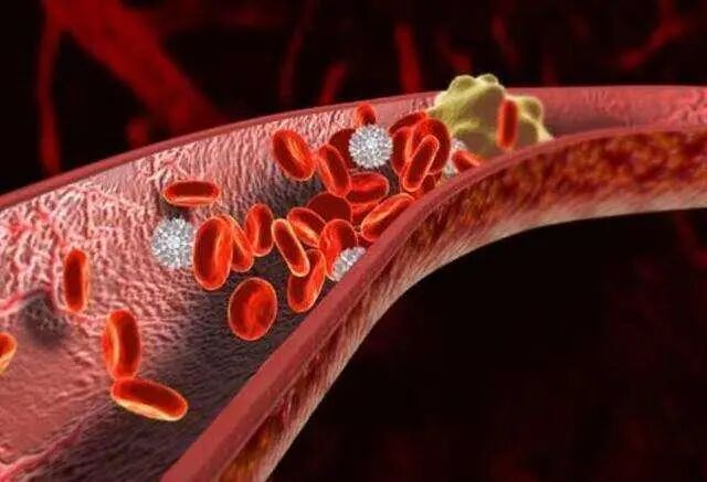 高血压，脑血栓的死对头，用这方法，远离心梗，脑梗，中风！！