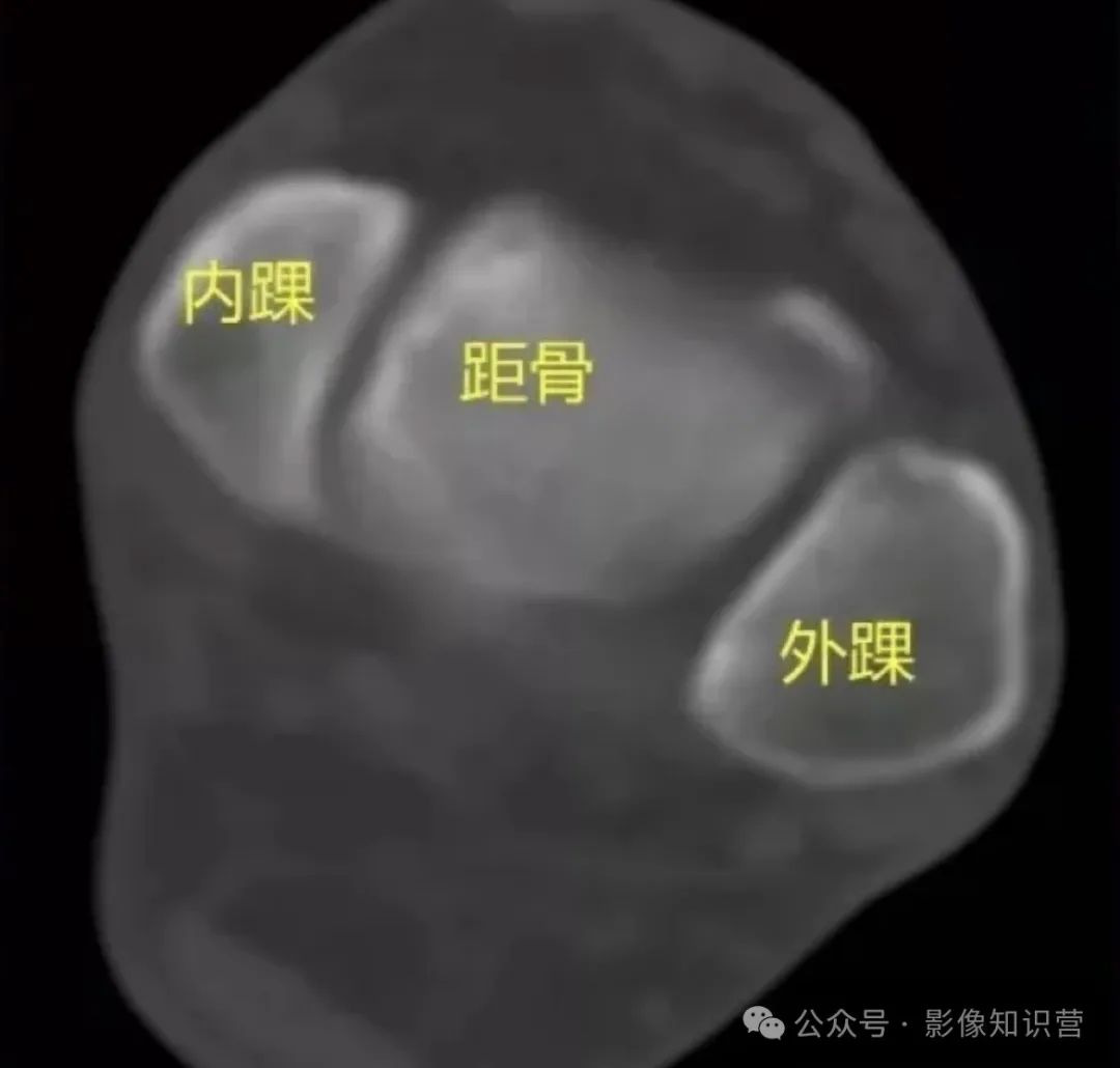 四肢骨骼影像解剖，一文掌握！