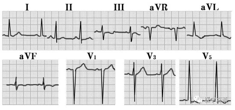 心电图总是记不住？这些基础知识一定要掌握！