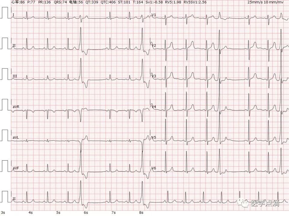 心电图总是记不住？这些基础知识一定要掌握！