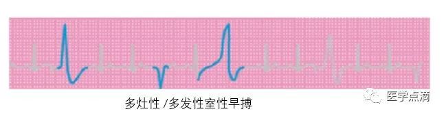 心电图总是记不住？这些基础知识一定要掌握！