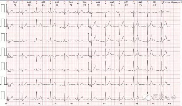 心电图总是记不住？这些基础知识一定要掌握！