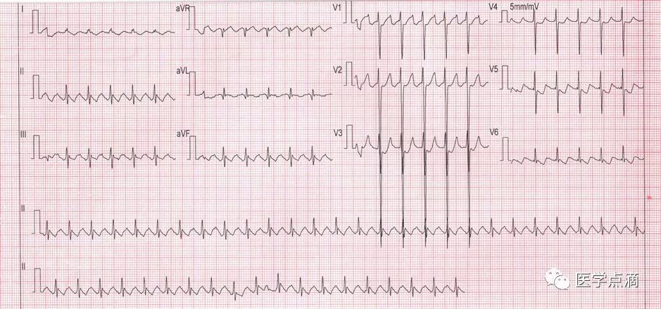 心电图总是记不住？这些基础知识一定要掌握！