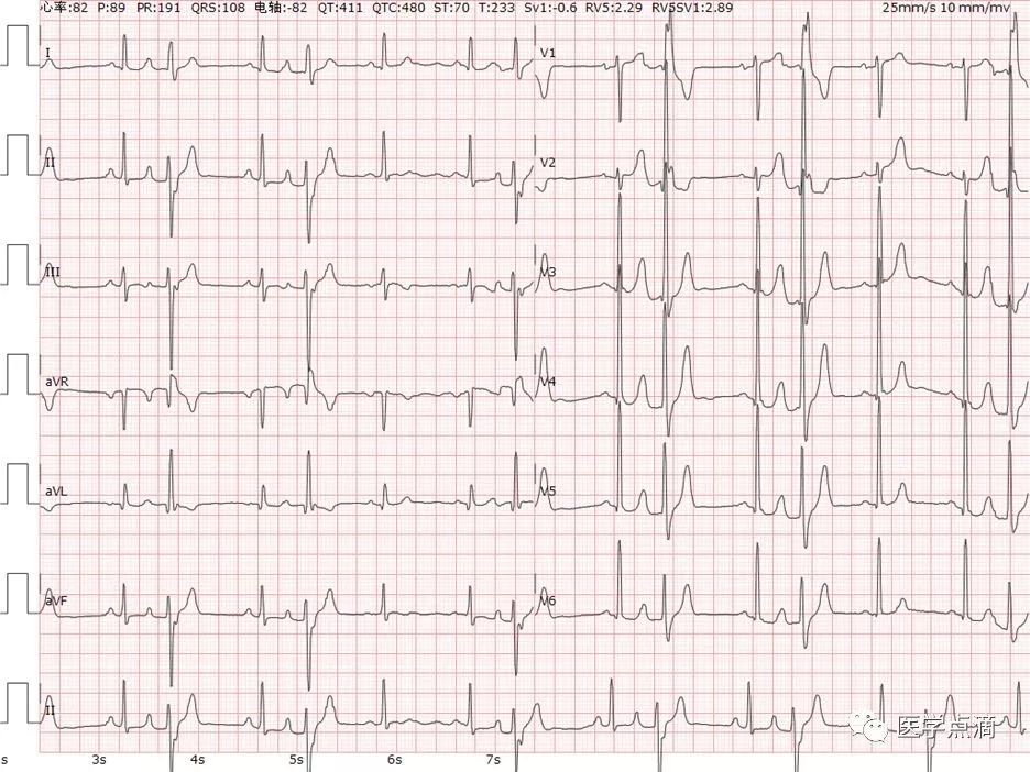 心电图总是记不住？这些基础知识一定要掌握！