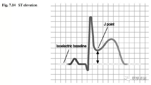 心电图总是记不住？这些基础知识一定要掌握！
