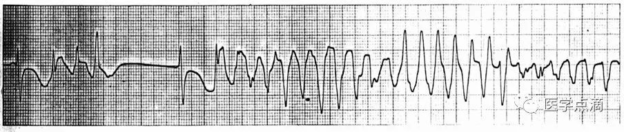 心电图总是记不住？这些基础知识一定要掌握！