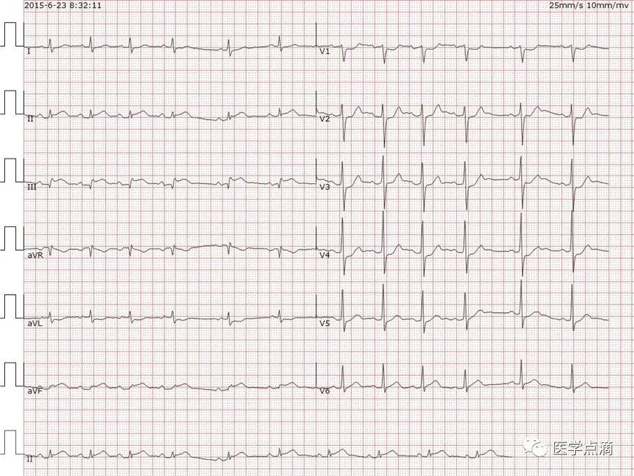 心电图总是记不住？这些基础知识一定要掌握！