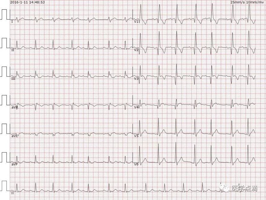 心电图总是记不住？这些基础知识一定要掌握！