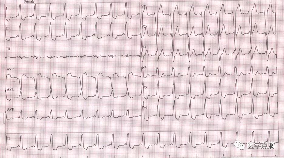 心电图总是记不住？这些基础知识一定要掌握！