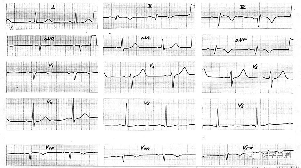 心电图总是记不住？这些基础知识一定要掌握！