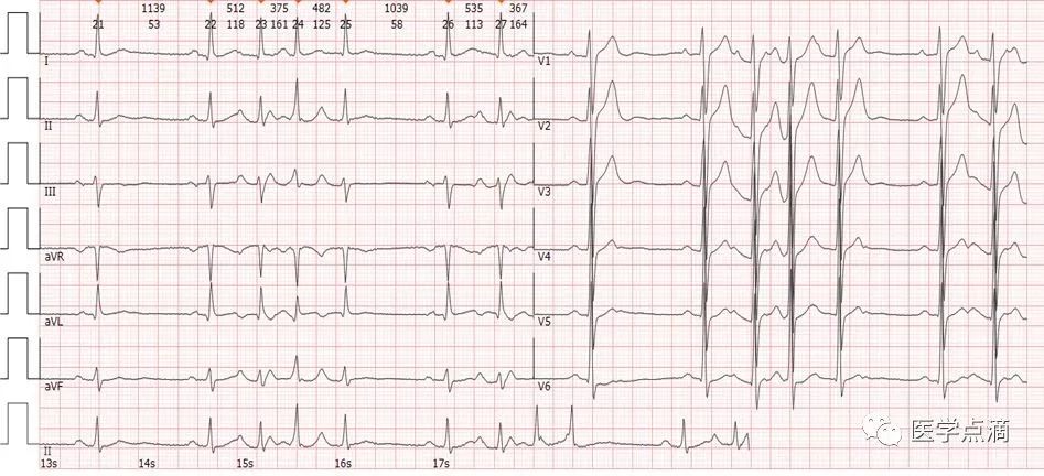 心电图总是记不住？这些基础知识一定要掌握！