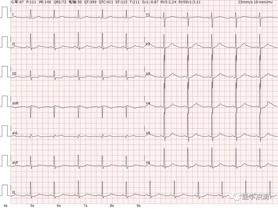 心电图总是记不住？这些基础知识一定要掌握！