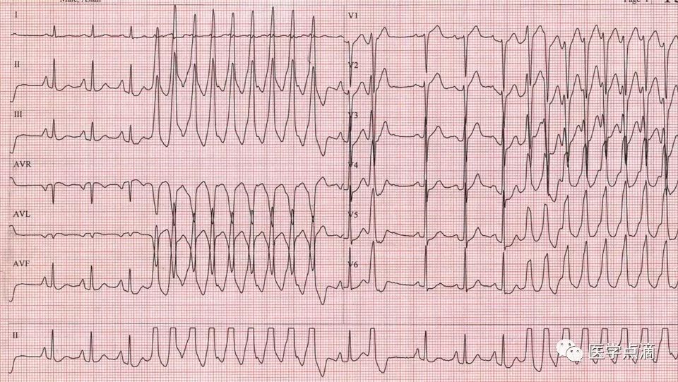 心电图总是记不住？这些基础知识一定要掌握！