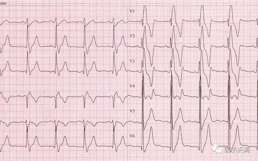 心电图总是记不住？这些基础知识一定要掌握！