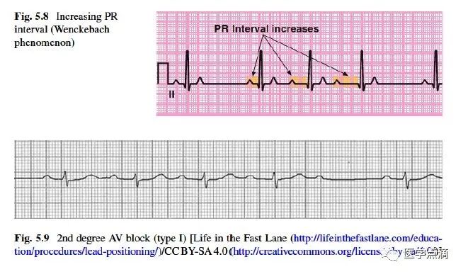 心电图总是记不住？这些基础知识一定要掌握！