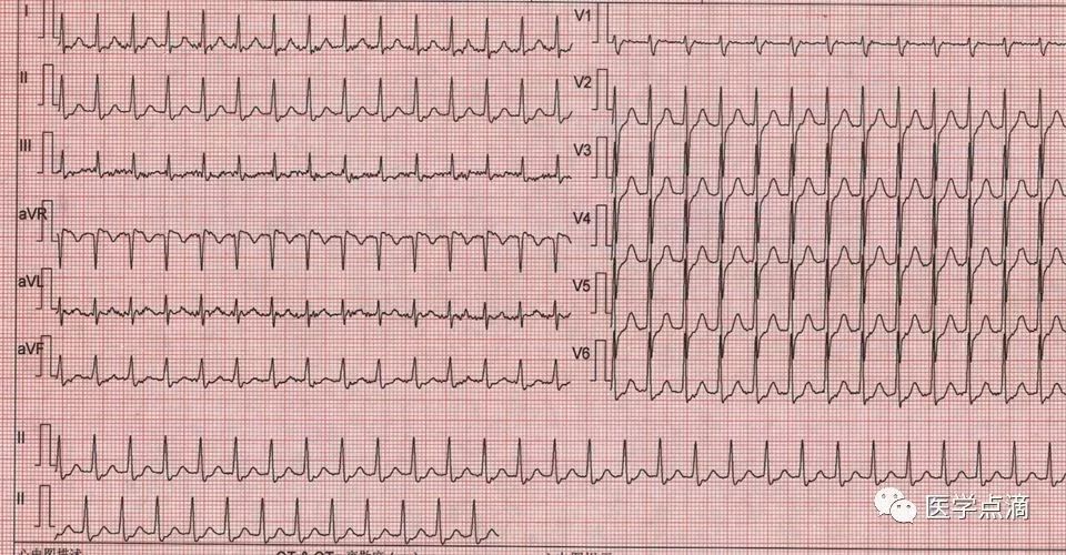 心电图总是记不住？这些基础知识一定要掌握！