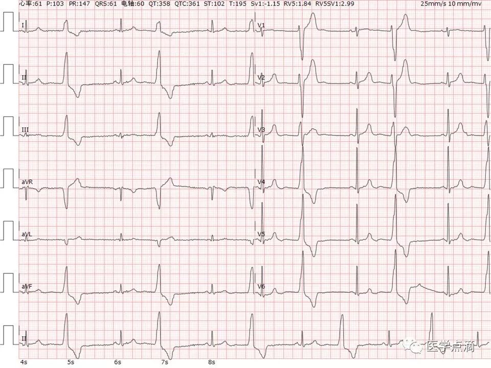 心电图总是记不住？这些基础知识一定要掌握！