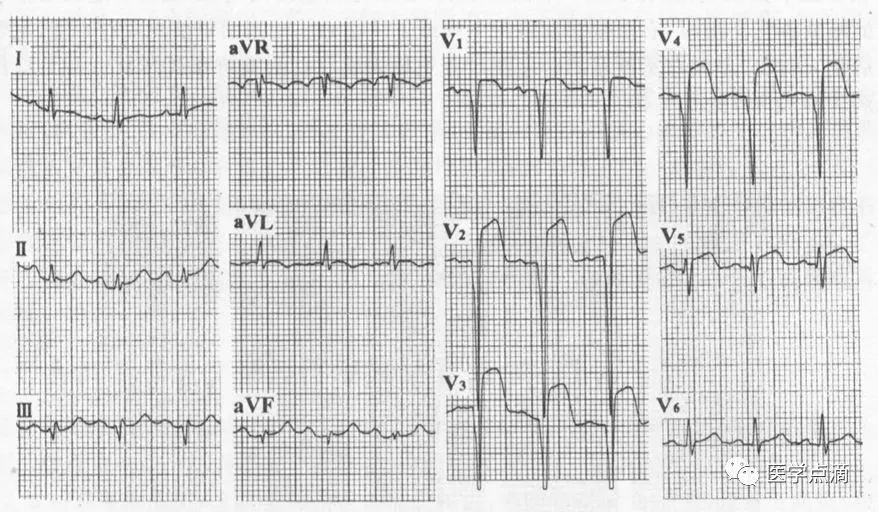 心电图总是记不住？这些基础知识一定要掌握！