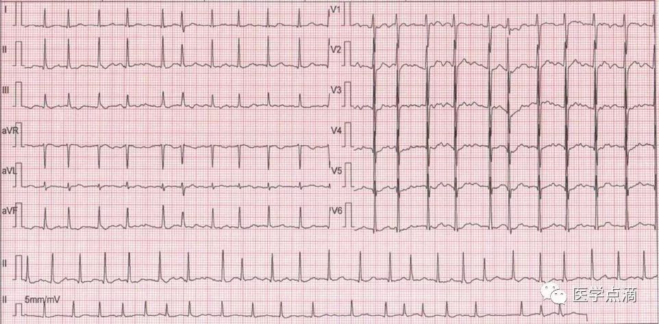 心电图总是记不住？这些基础知识一定要掌握！