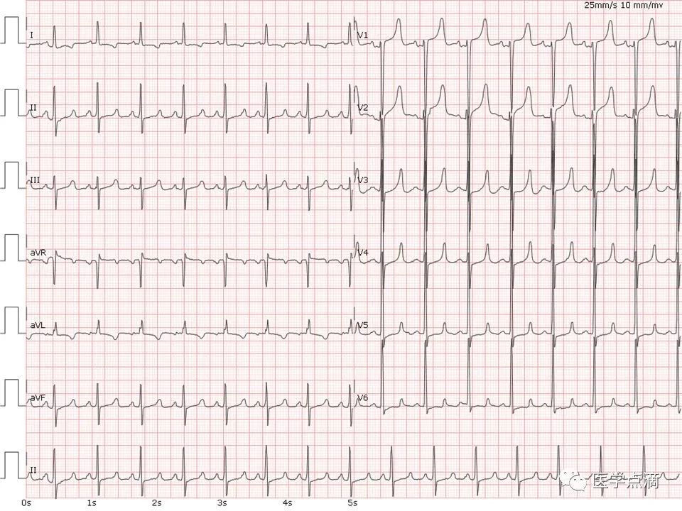 心电图总是记不住？这些基础知识一定要掌握！