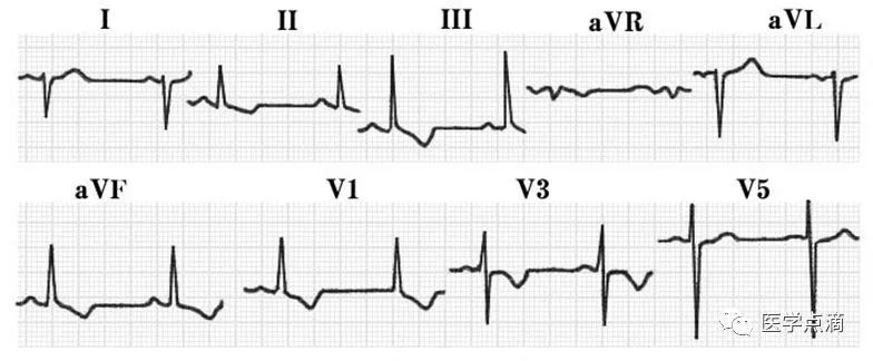 心电图总是记不住？这些基础知识一定要掌握！